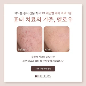 멜로우피부과 여드름 치료 후기