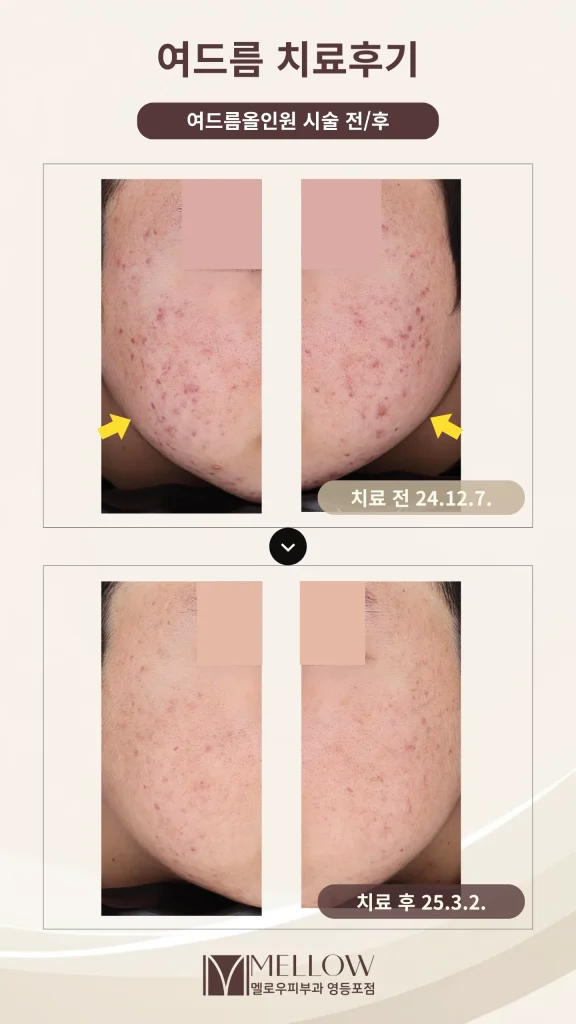 20대 남성 염증성 여드름 치료 후기