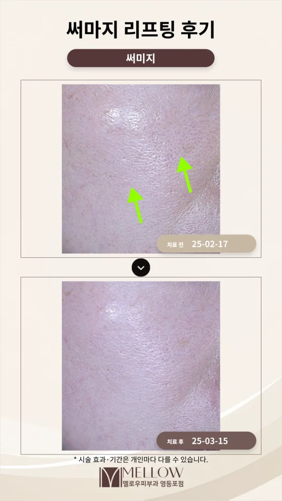 앞볼 처짐 써마지 리프팅 후기_피부과 전문의