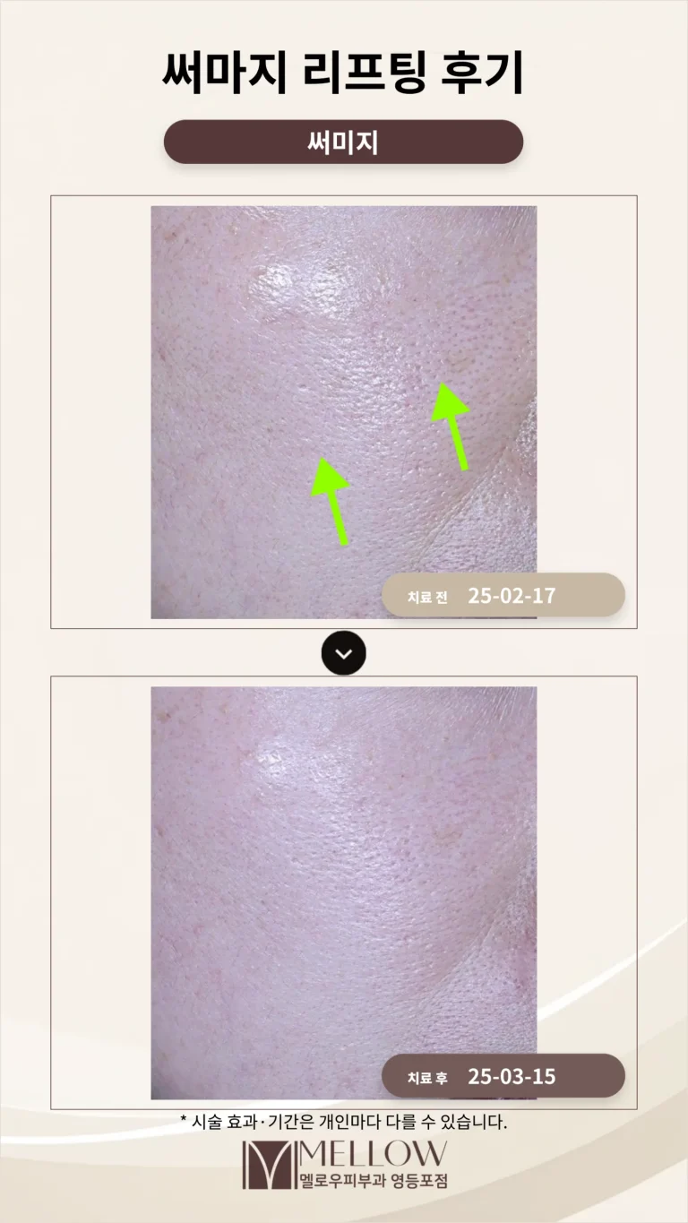 앞볼 처짐 써마지 리프팅 후기_피부과 전문의