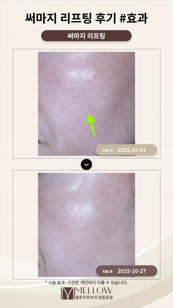 50대 써마지 리프팅 후기 #효과