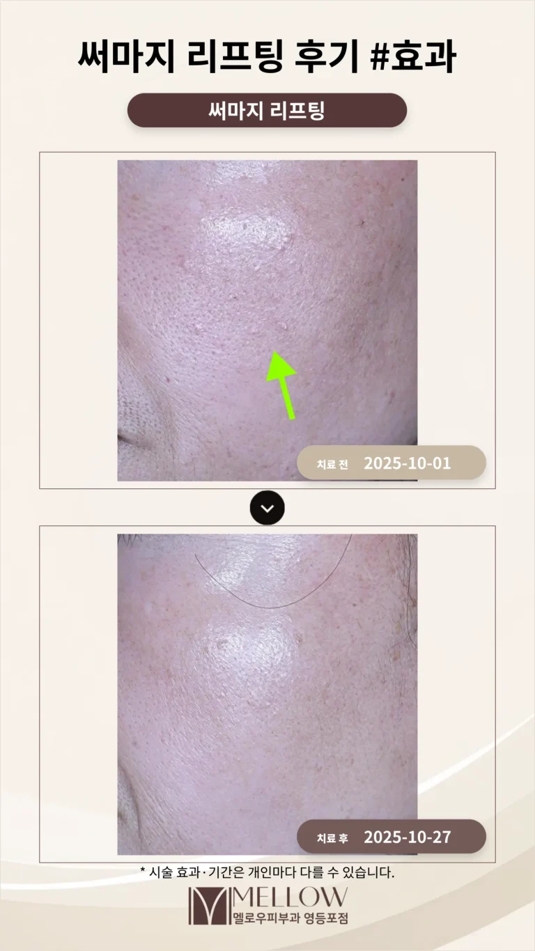 50대 써마지 리프팅 후기 #효과