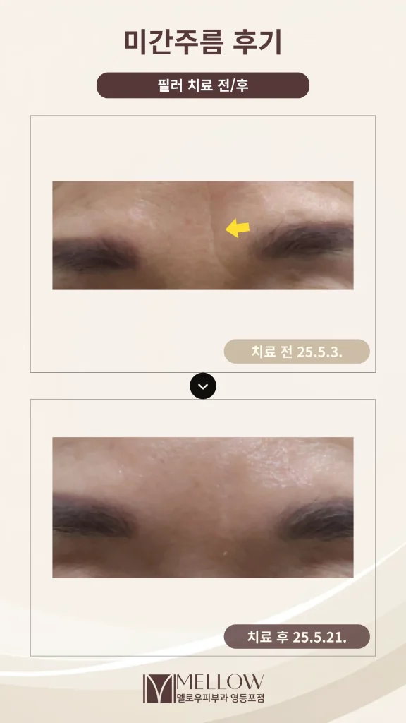 60대 여성 미간 주름 치료 후기 #필러