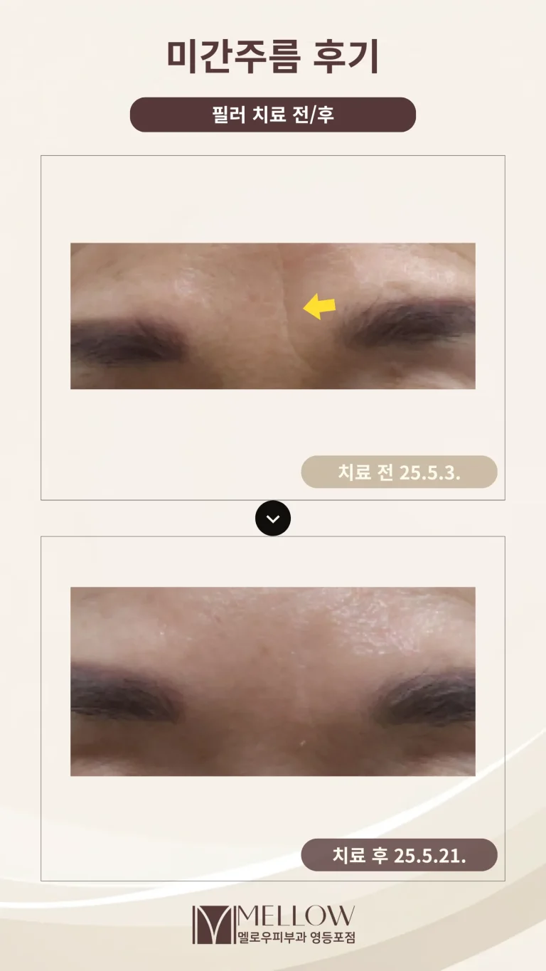 60대 여성 미간 주름 치료 후기 #필러