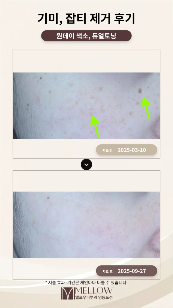 40대 기미, 잡티 제거 후기 #부작용 적은 레이저 치료 방법