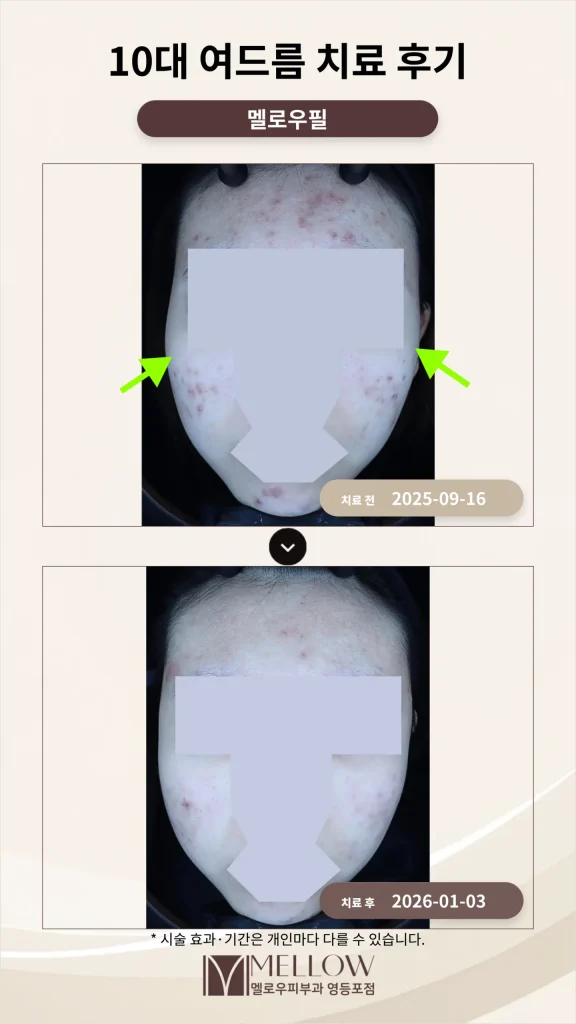 10대 여드름 치료 후기