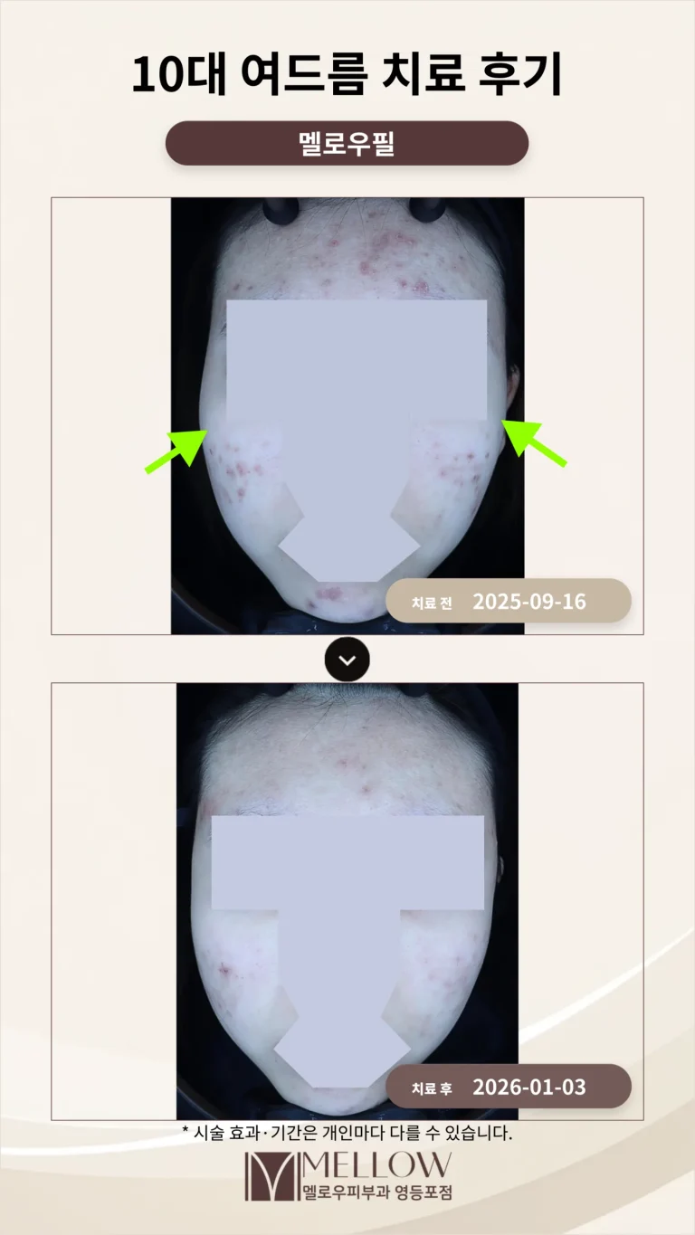 10대 여드름 치료 후기