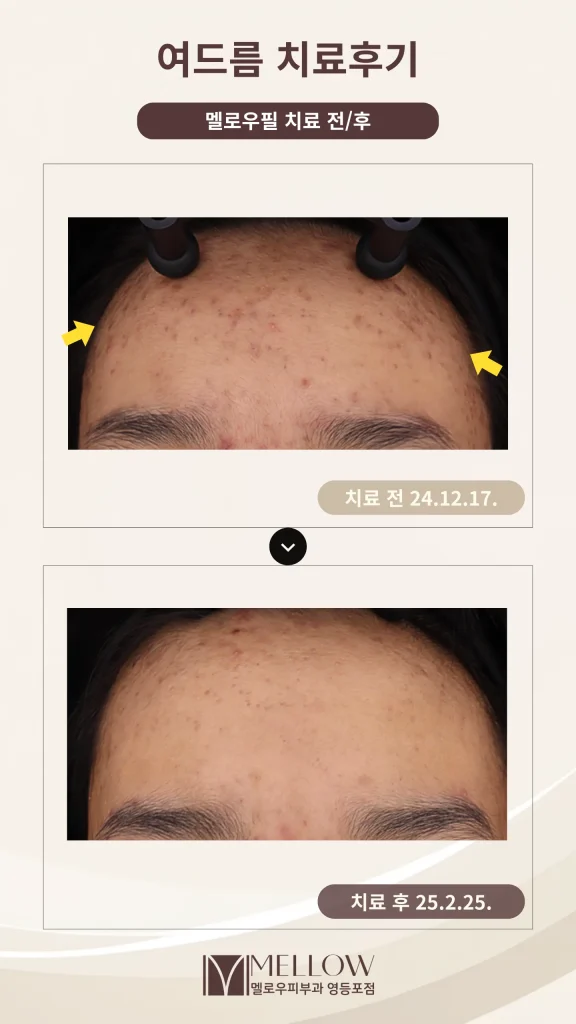 10대 이마 염증성여드름 치료 후기