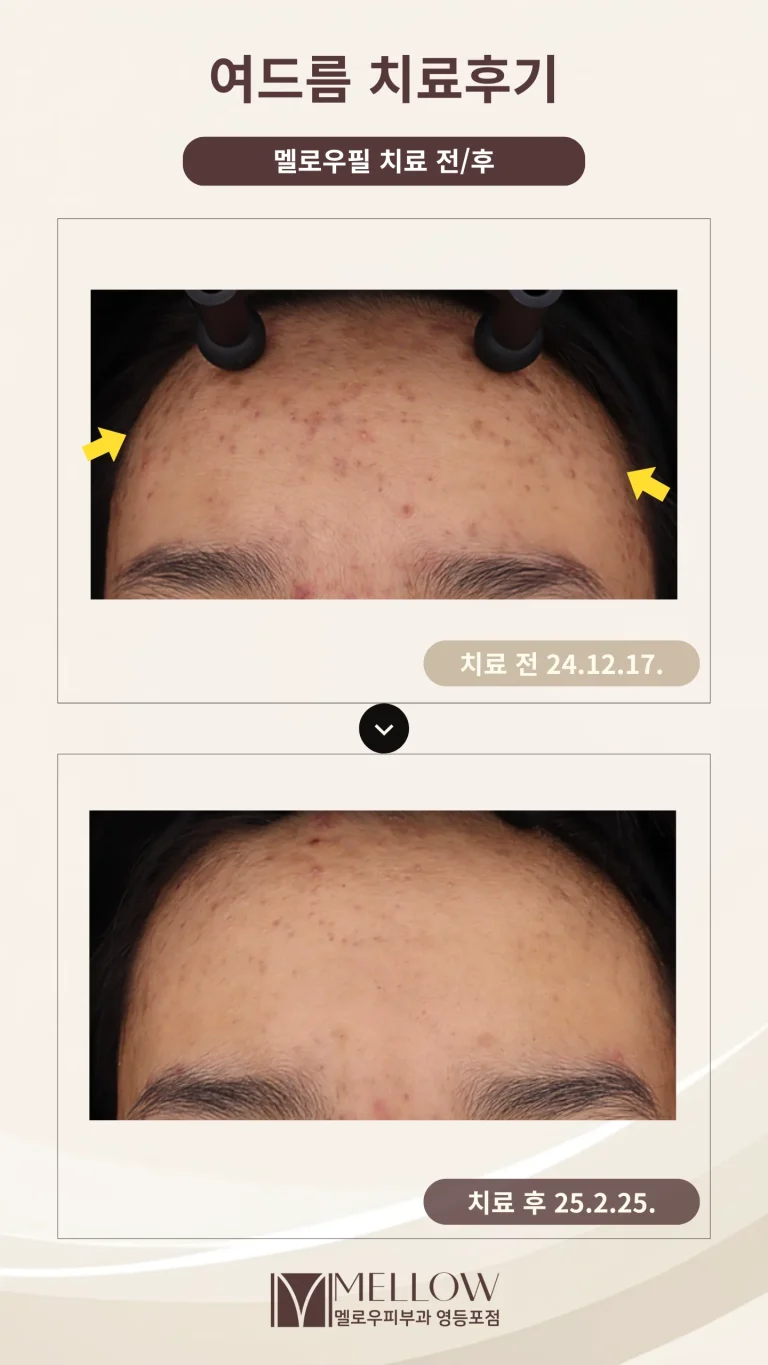 10대 이마 염증성여드름 치료 후기