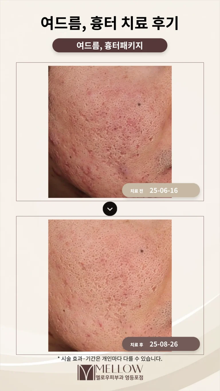 30대 여드름, 여드름 흉터 치료 후기_치료과정 소개