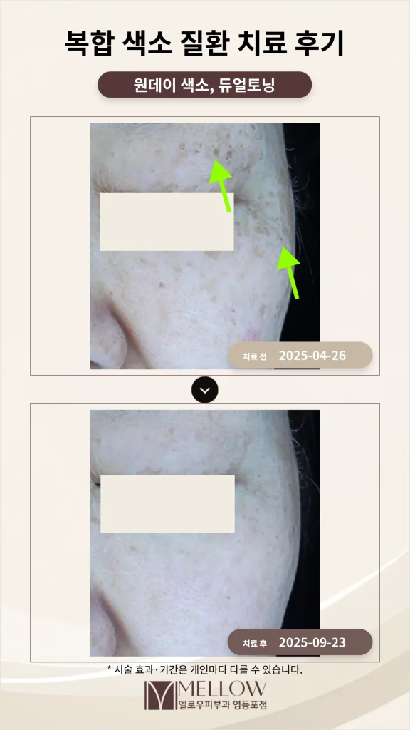 60대 기미, 잡티, 흑자 복합 색소 질환 치료 후기 #색소 레이저 치료효과