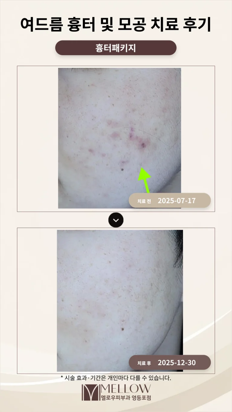 여드름 흉터 및 모공 치료 후기