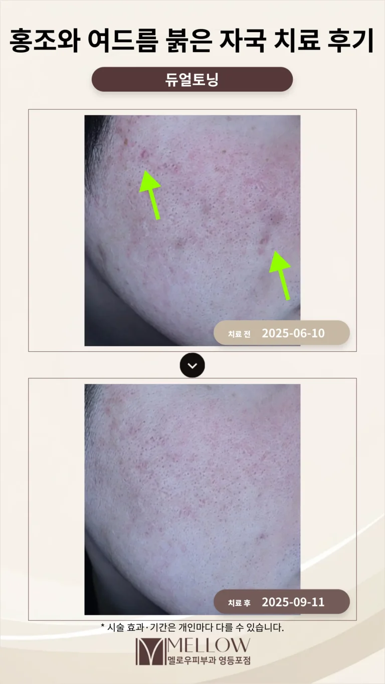 30대 남성 홍조와 여드름 붉은 자국 차료 후기 #레이저치료