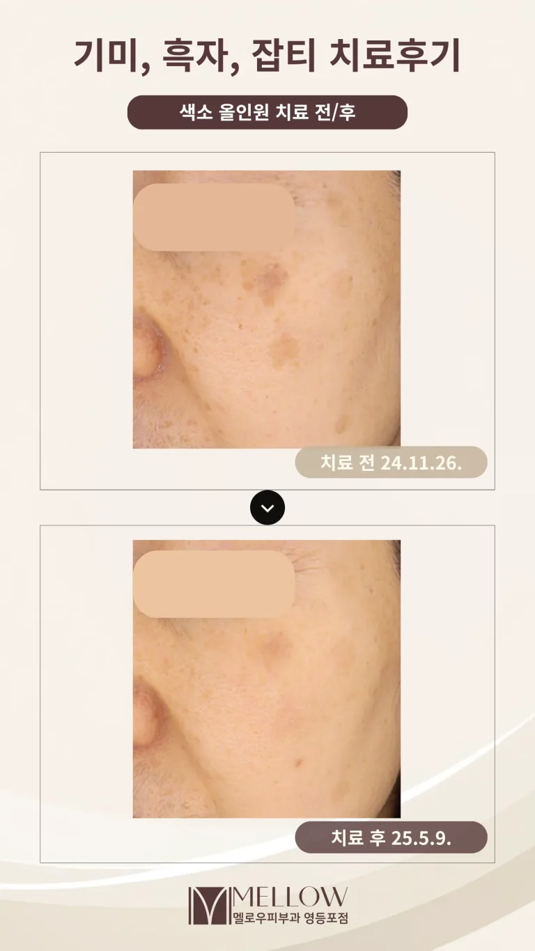 50대 여성 기미, 흑자, 잡티 혼재 치료 후기 #색소올인원