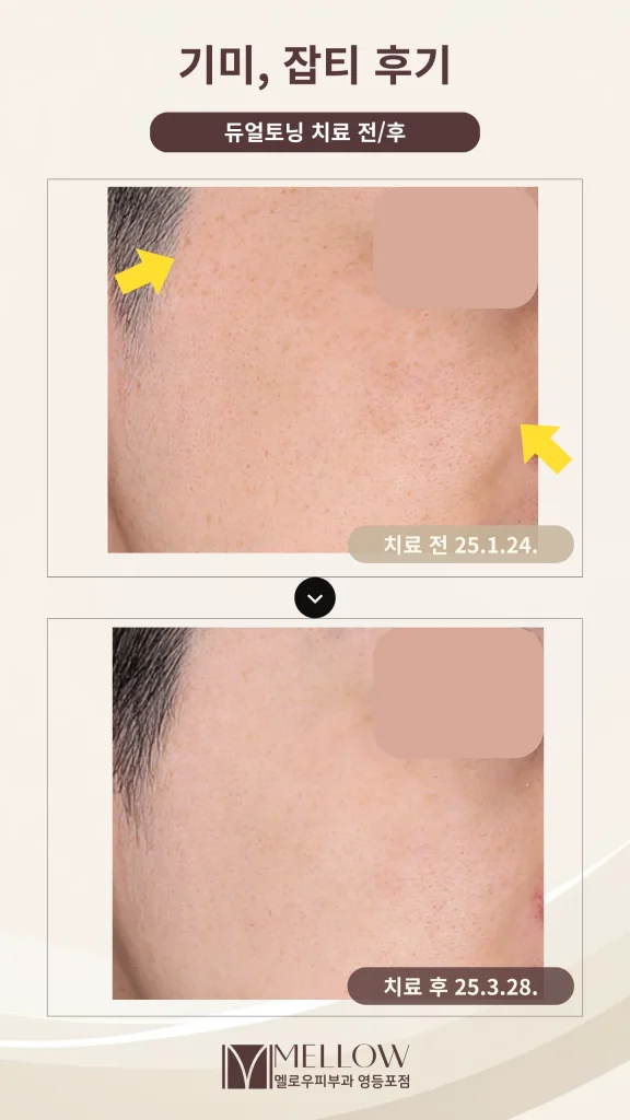 30대 남성 기미, 잡티 피부과 치료 후기 #듀얼토닝 10회