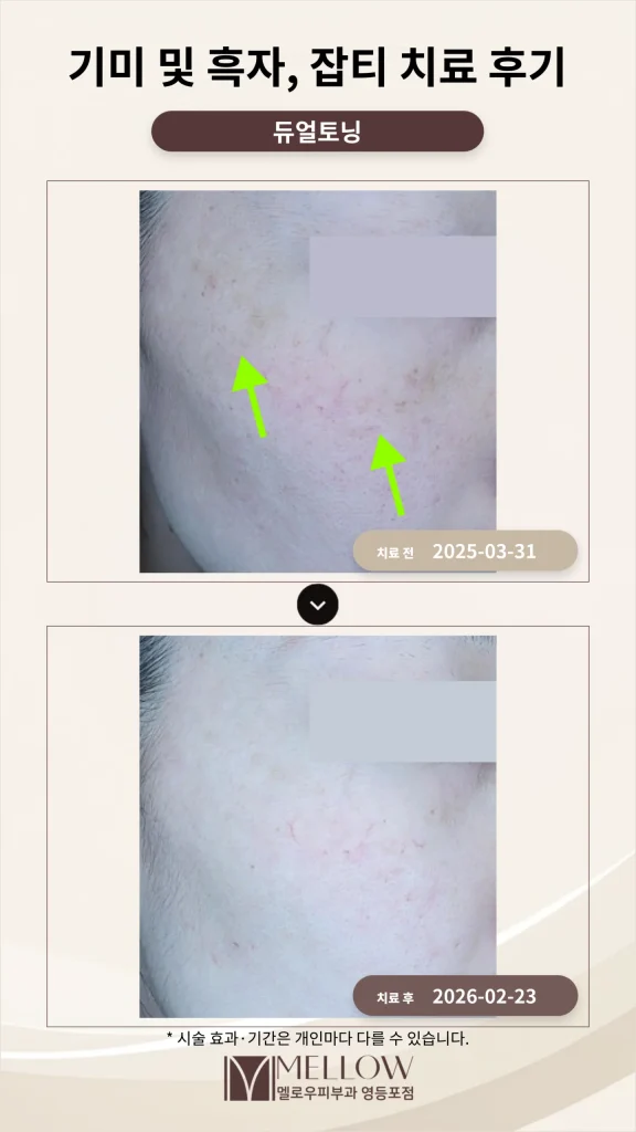 기미 및 흑자, 잡티 치료 후기
