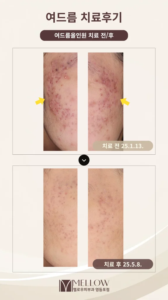10대 여드름 치료 후기 #여드름올인원