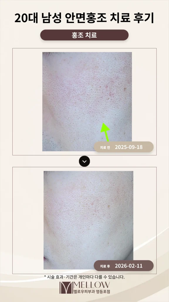 20대 남성 안면홍조 치료 후기
