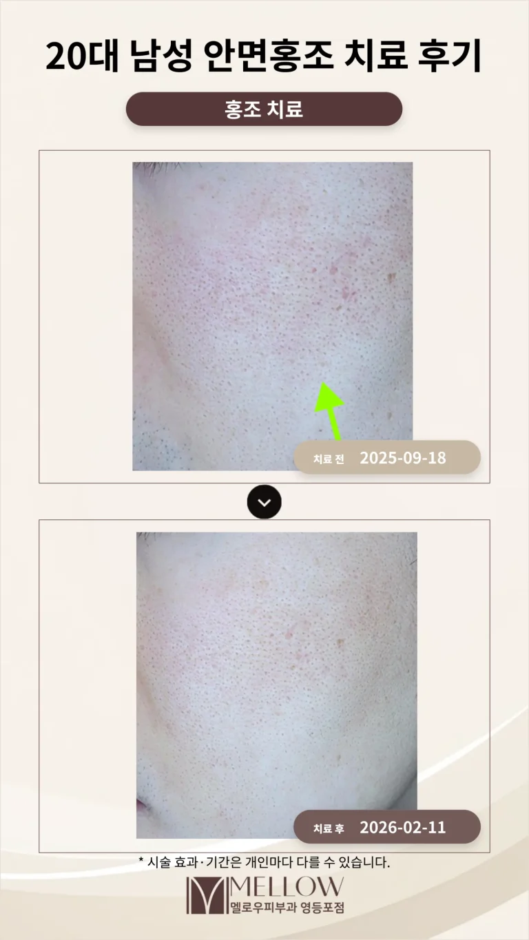 20대 남성 안면홍조 치료 후기