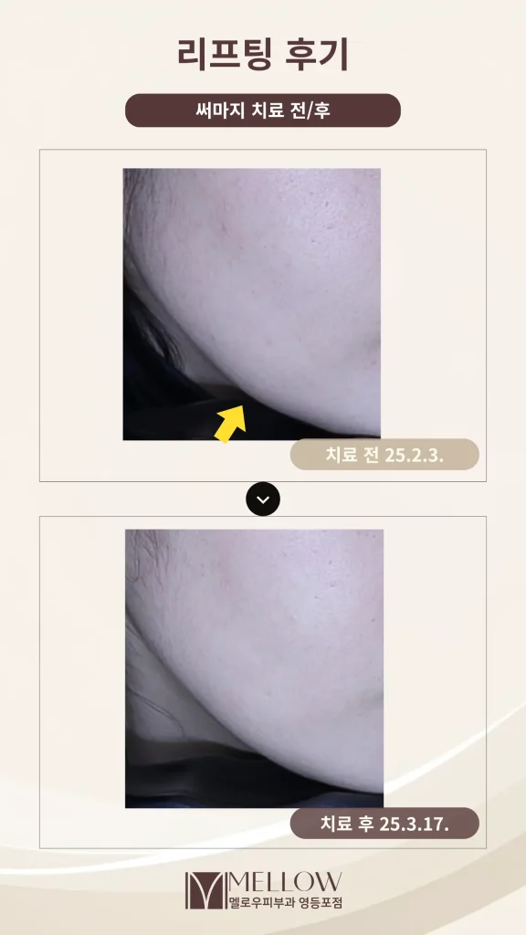 30대 여성 써마지 리프팅 상담 후기
