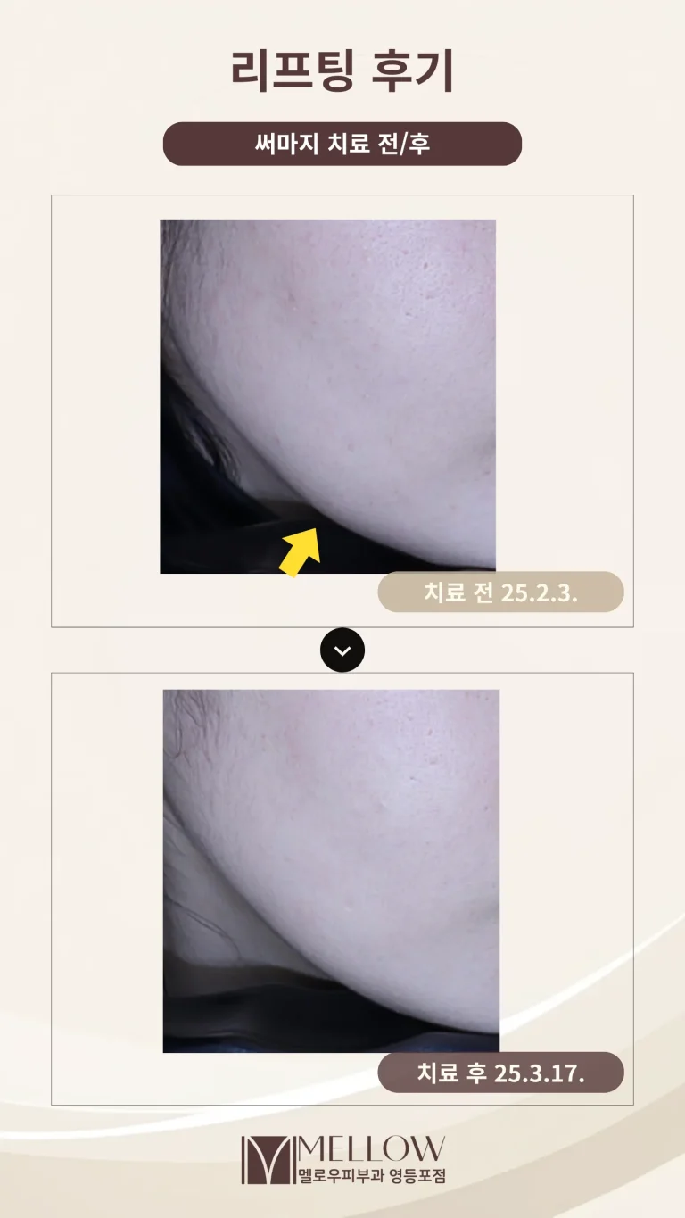30대 여성 써마지 리프팅 상담 후기