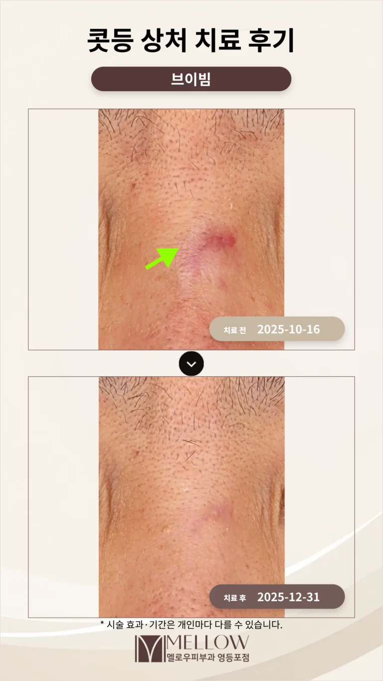 콧등 상처 치료 후기