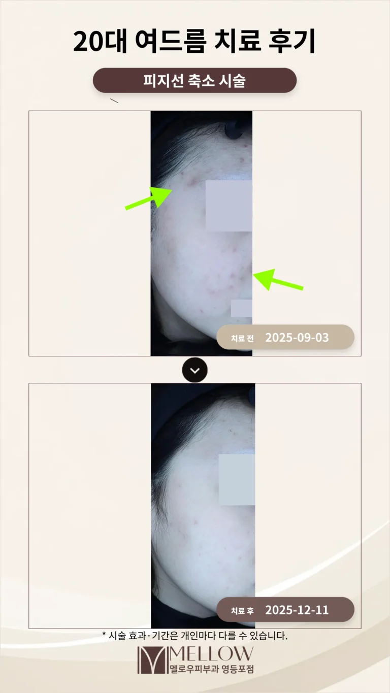 20대 여드름 치료 후기