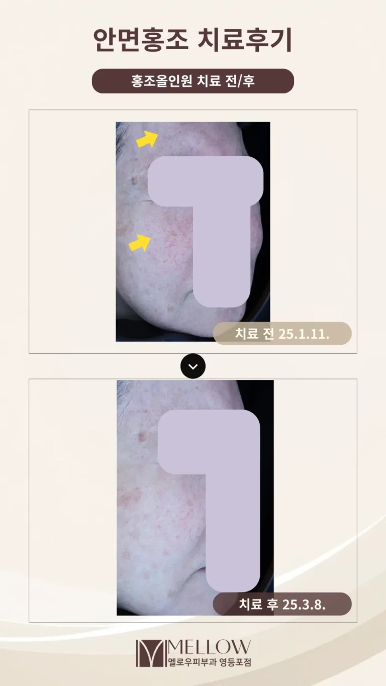 60대 여성 안면홍조, 핏줄비침 치료 후기 #클라리티