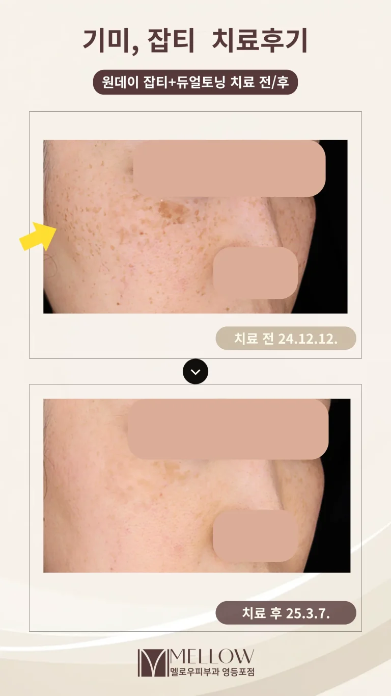 40대 여성 기미, 잡티 레이저토닝 치료 후기