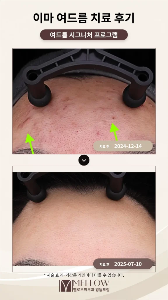 염증성 이마 여드름 치료 후기 #여드름 재발을 최소화하는 방법
