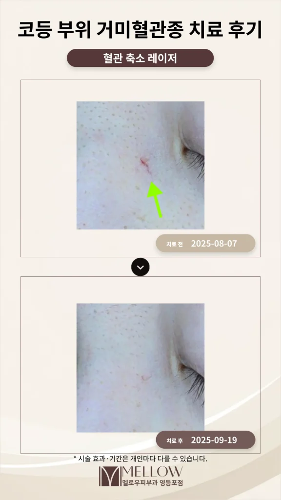 30대 코등 부위 붉은 자국, 거미혈관종 치료 후기