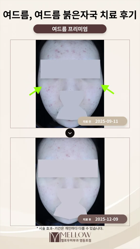 여드름, 여드름 붉은자국 치료 후기