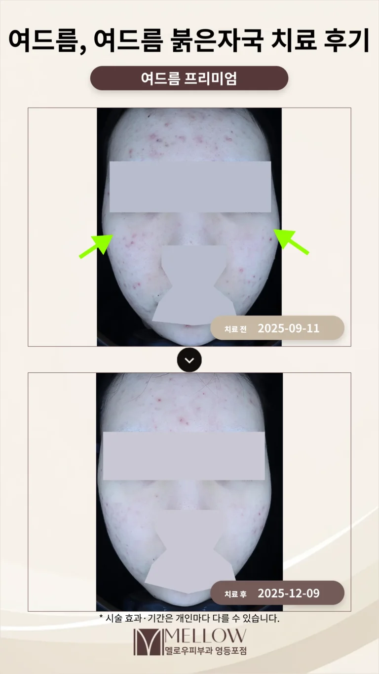 여드름, 여드름 붉은자국 치료 후기