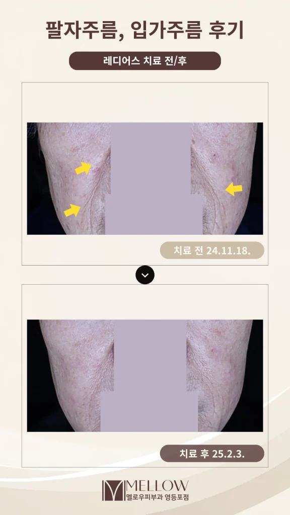 60대 여성 팔자주름, 입가주름 개선 후기 #래디어스 후기