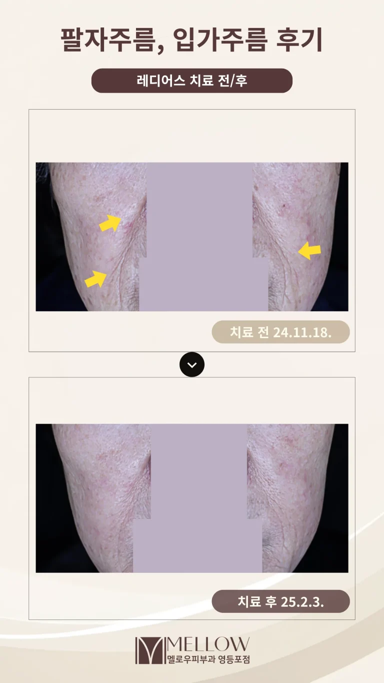 60대 여성 팔자주름, 입가주름 개선 후기 #래디어스 후기