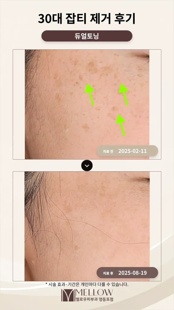 30대 얼굴 잡티, 기미 제거 후기_보라매피부과