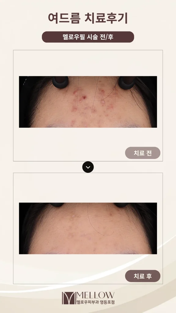 10대의 이마 염증성여드름, 치료 후 변화는?