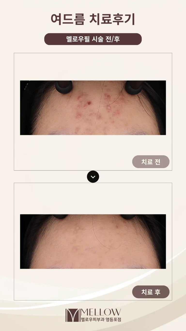 10대의 이마 염증성여드름, 치료 후 변화는?