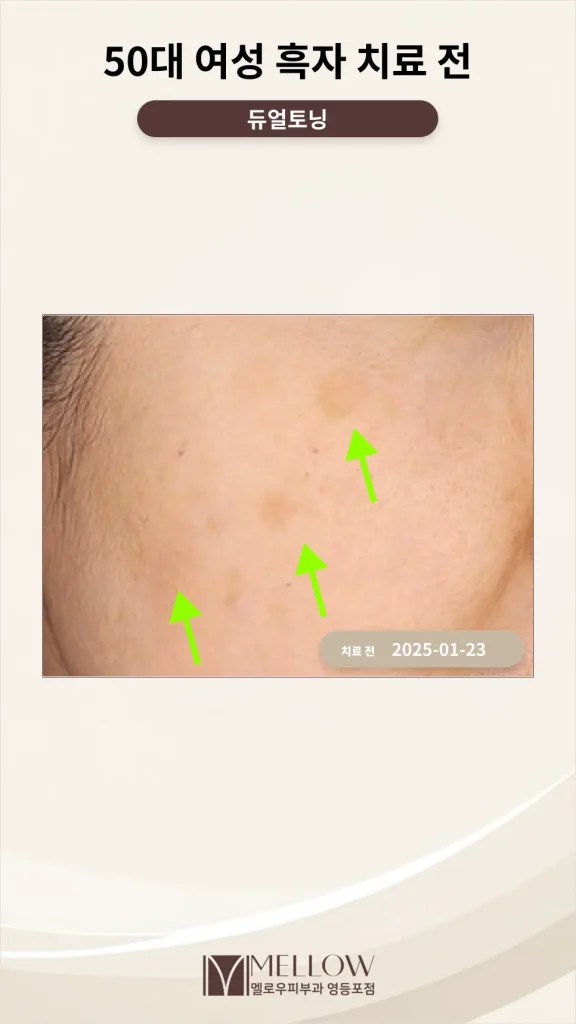 50대 여성 흑자 제거 후기 #피부톤 개선 방법