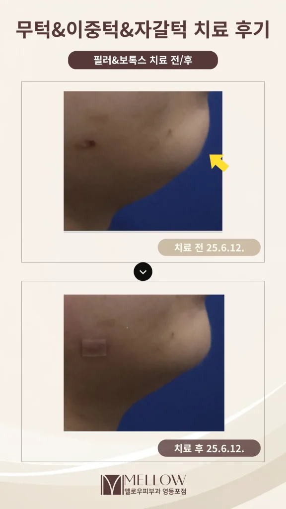 20대 여성 무턱, 이중턱 필러 시술 후기
