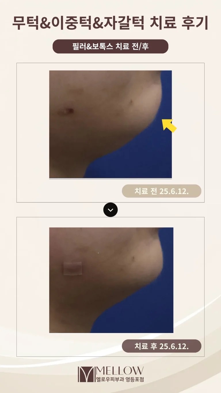 20대 여성 무턱, 이중턱 필러 시술 후기