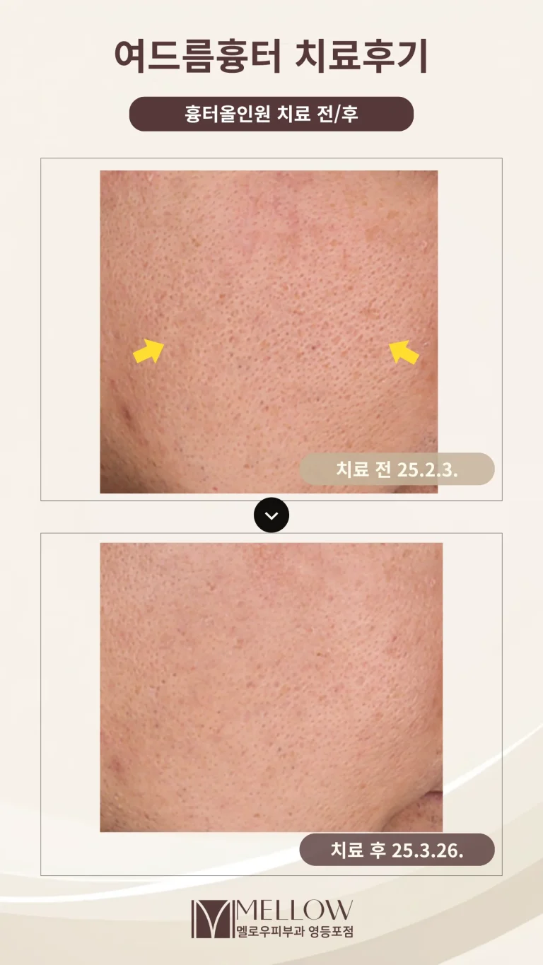 30대 남성 여드름흉터 피부과 치료후기 #여드름흉터