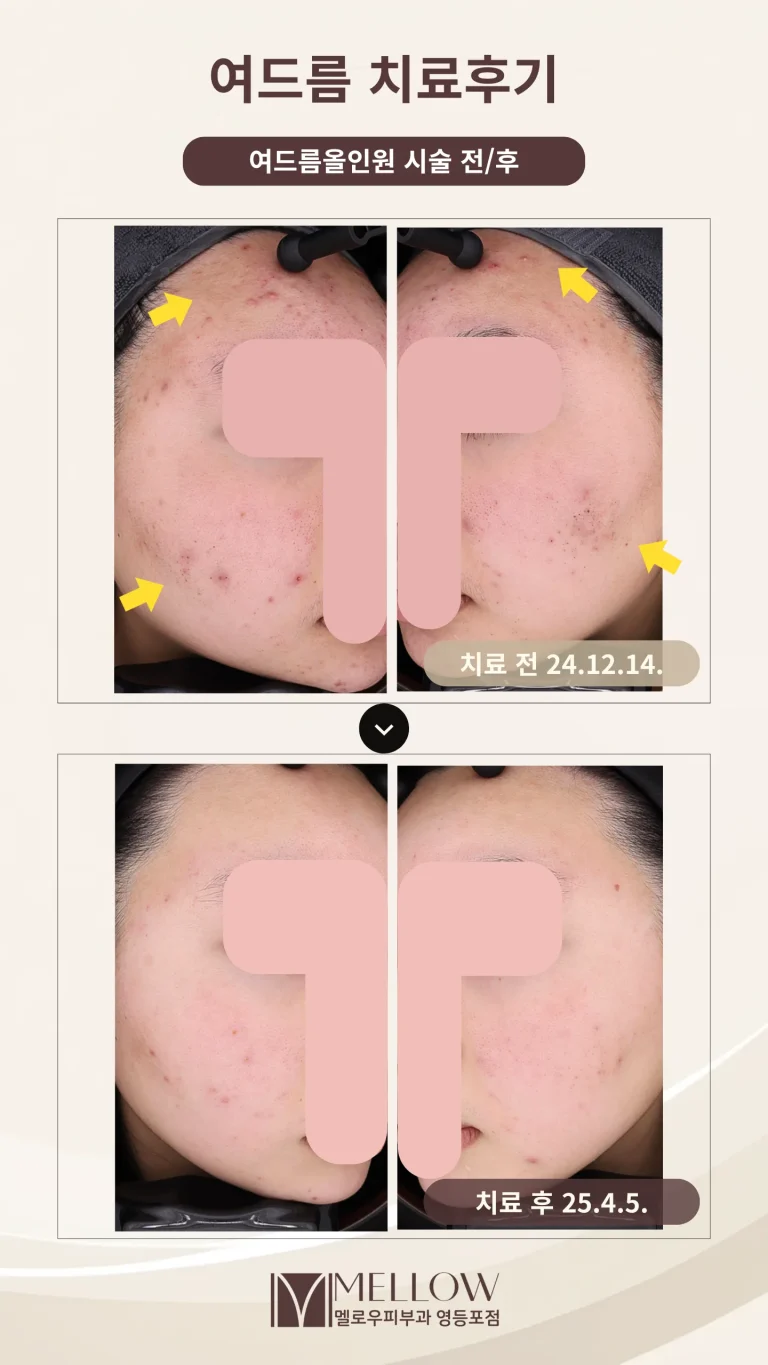 20대 피부 트러블을 해결한 올인원 여드름 치료 후기