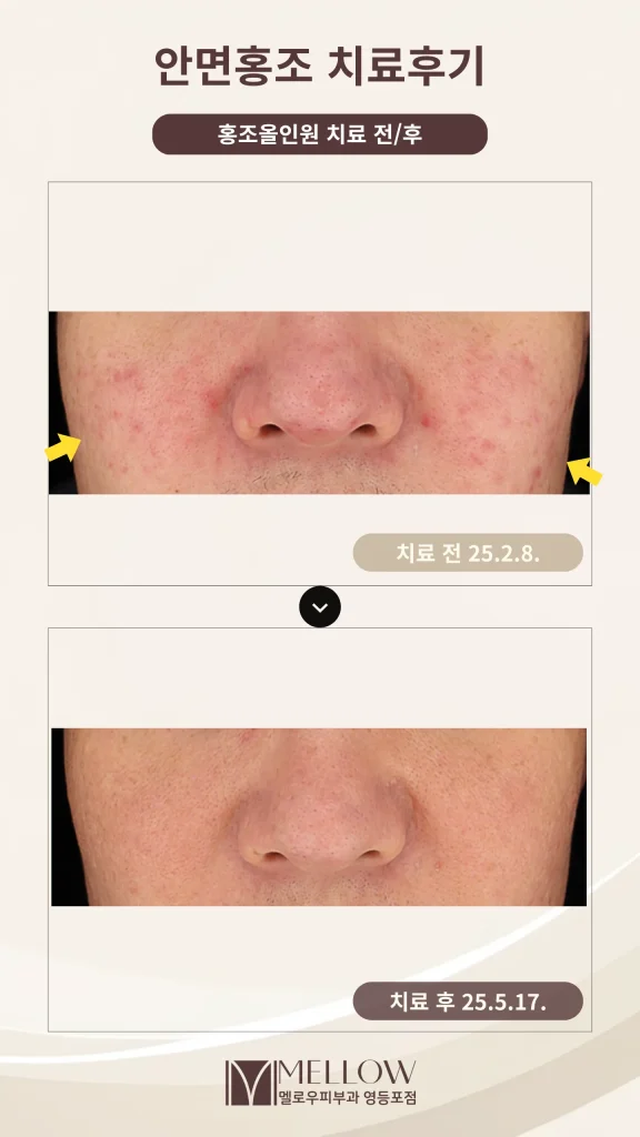 50대 남성 안면홍조 피부과 치료 후기 #홍조올인원