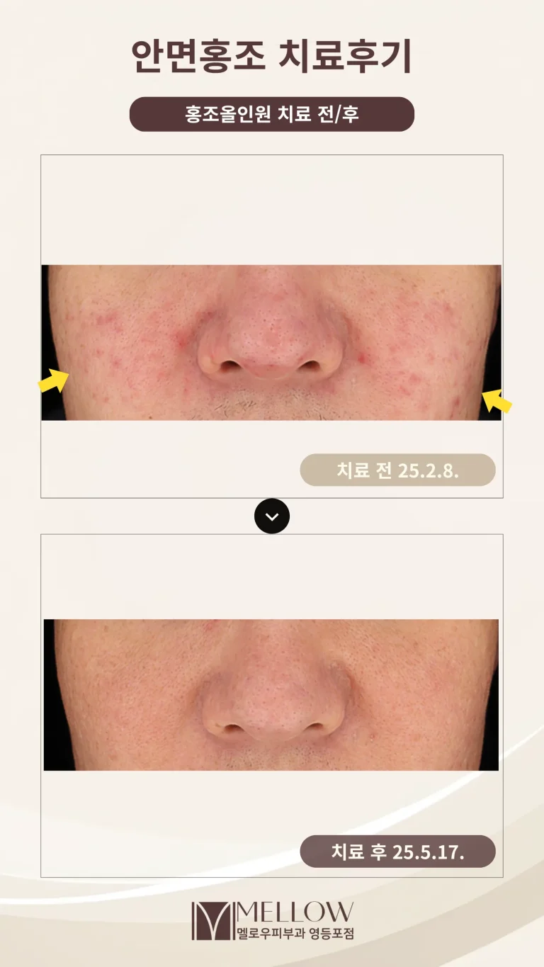 50대 남성 안면홍조 피부과 치료 후기 #홍조올인원