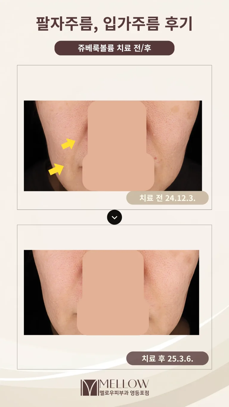 50대 여성 팔자주름, 입가주름 개선 후기 #쥬베룩 볼륨