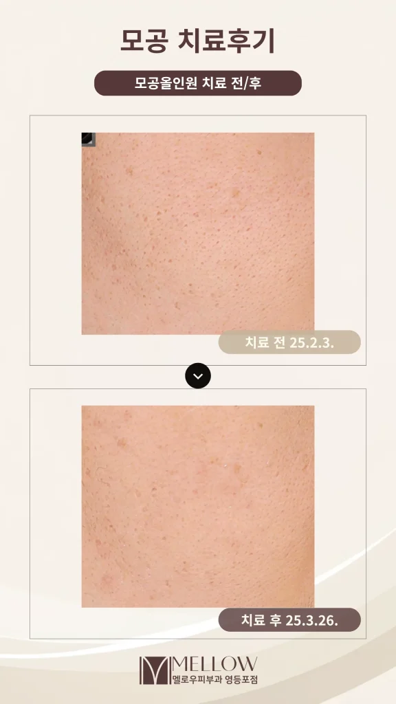 20대 여성 모공 치료 후기 #모공올인원