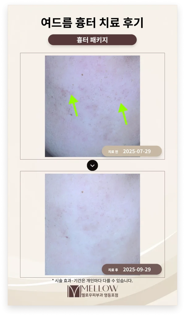 20대 여드름 흉터 치료 후기 #여드름 흉터 치료방법 소개
