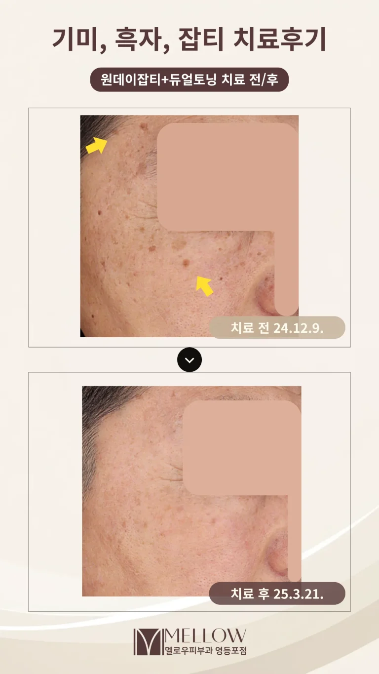 60대 남성 흑자, 기미, 잡티 레이저 치료 후기