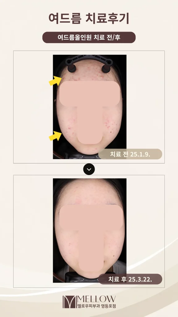 10대 여성 환자 염증성여드름 극복 후기